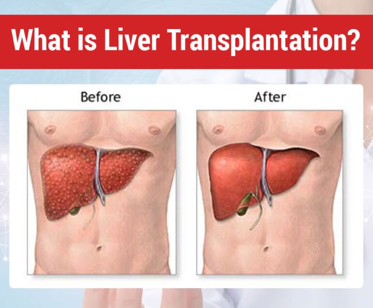 What is Liver Transplantation?