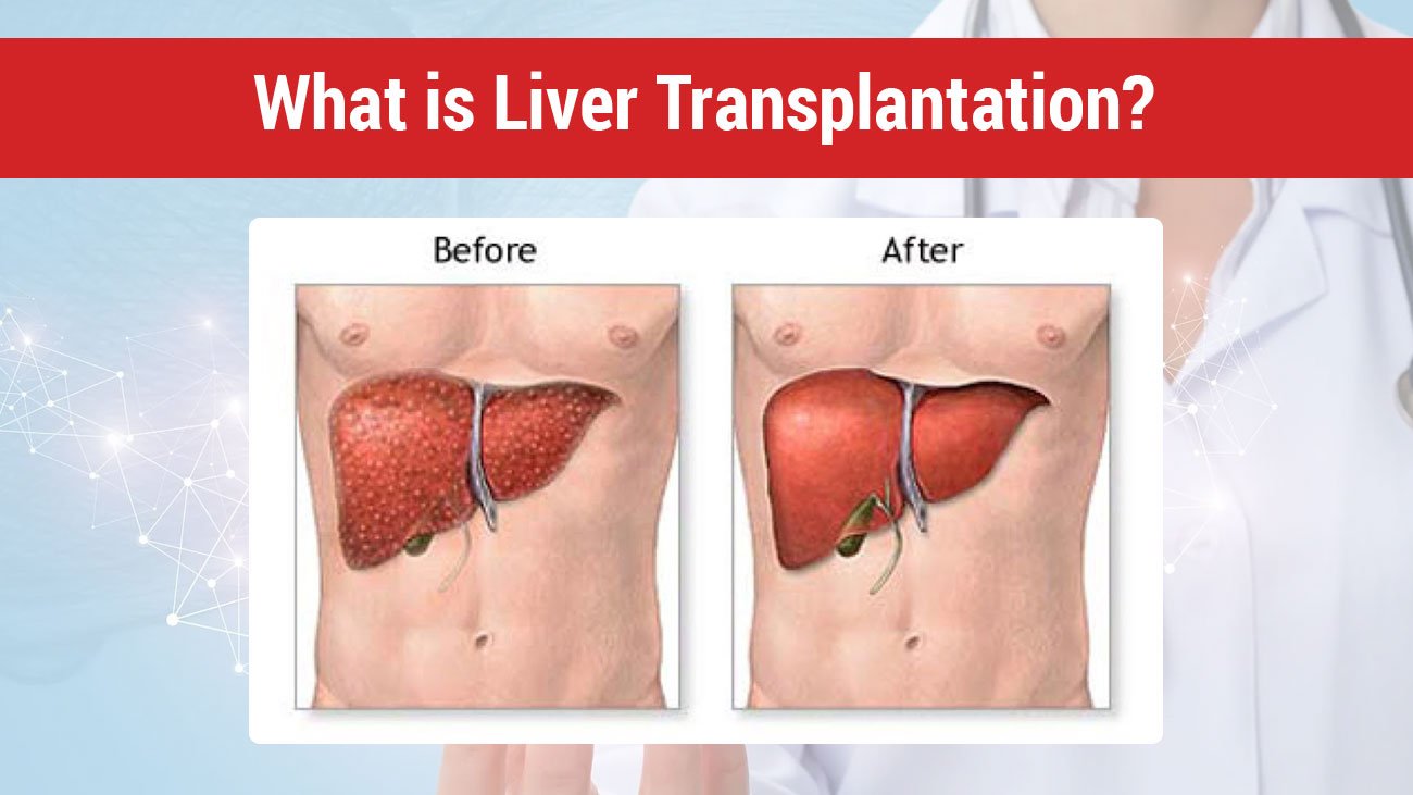What is Liver Transplantation?
