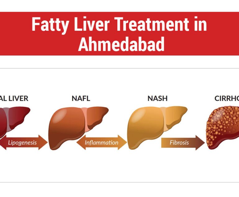 Fatty Liver Treatment in Ahmedabad