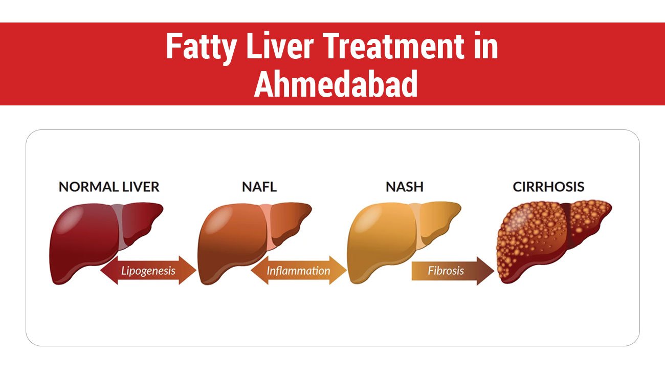 Fatty Liver Treatment in Ahmedabad