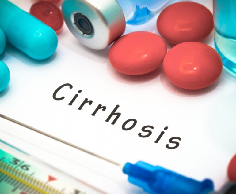 Liver cirrhosis