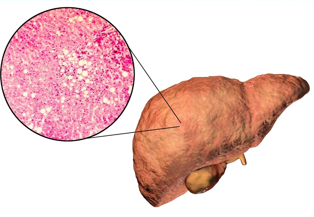 What is liver biopsy required
