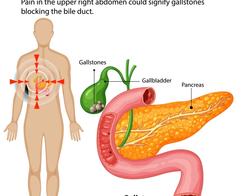 gallbladder stone pain location in upper right abdomen diagram