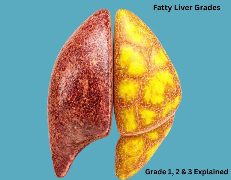 fatty liver grades 1 2 3 explained comparison normal vs fatty liver illustration
