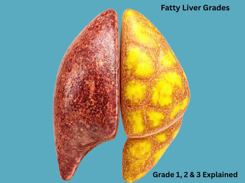 fatty liver grades 1 2 3 explained comparison normal vs fatty liver illustration