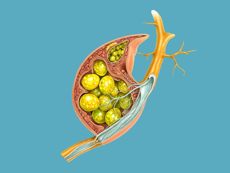 gallbladder-stones-bile-duct