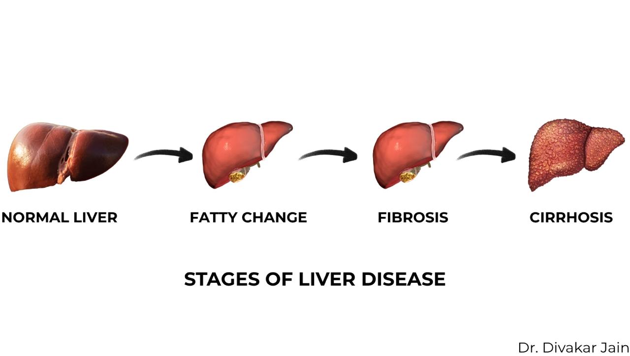 liver cirrhosis stages progression from healthy liver to damaged liver