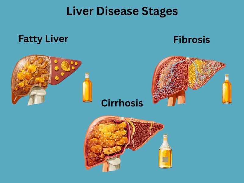 liver disease stages fatty liver fibrosis cirrhosis progression diagram