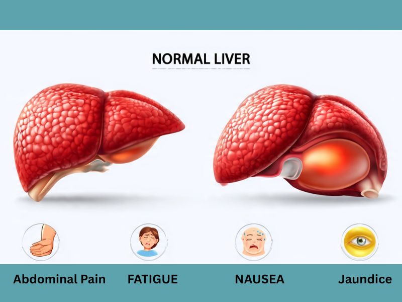 normal liver versus enlarged liver symptoms comparison