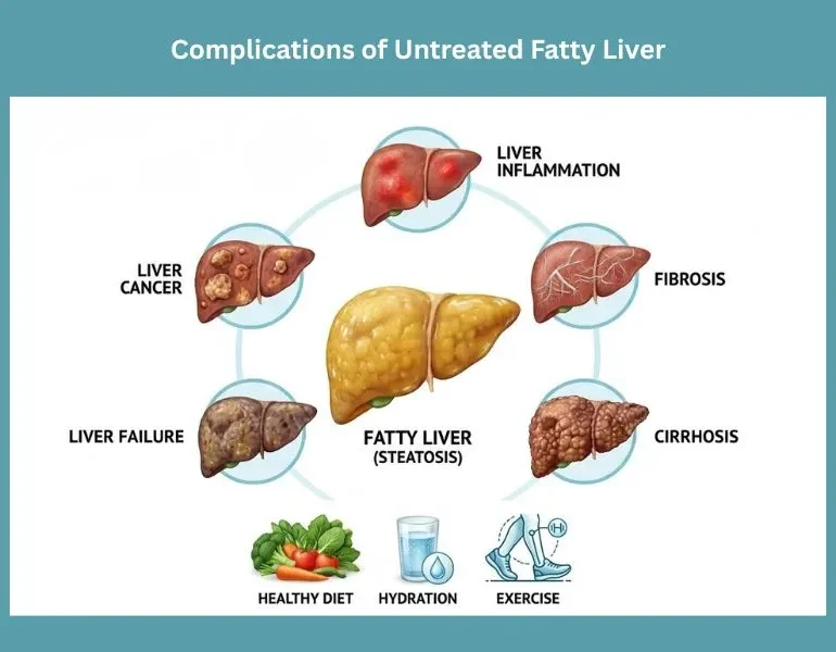 complications of untreated fatty liver including inflammation fibrosis cirrhosis liver failure and liver cancer