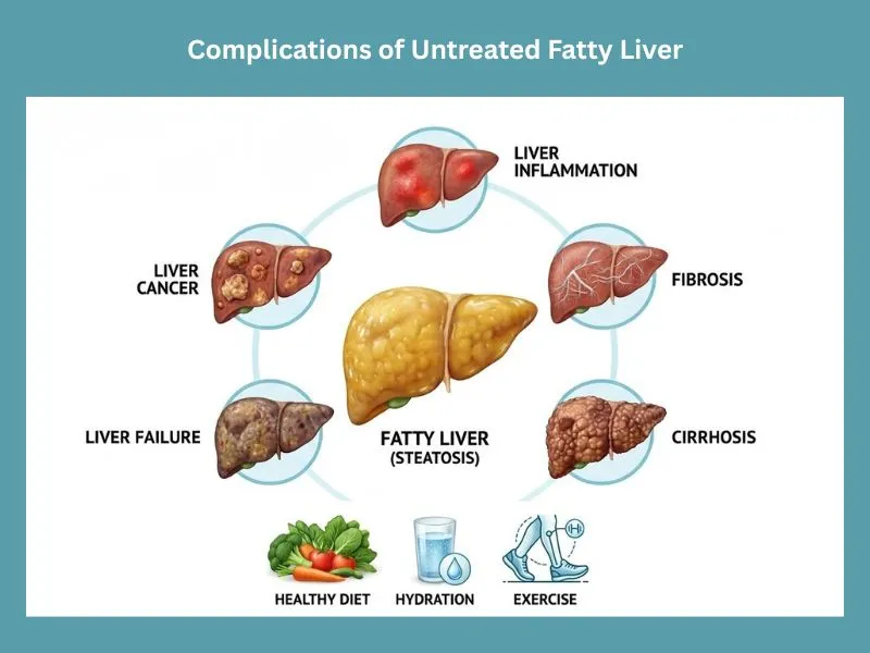 complications of untreated fatty liver including inflammation fibrosis cirrhosis liver failure and liver cancer
