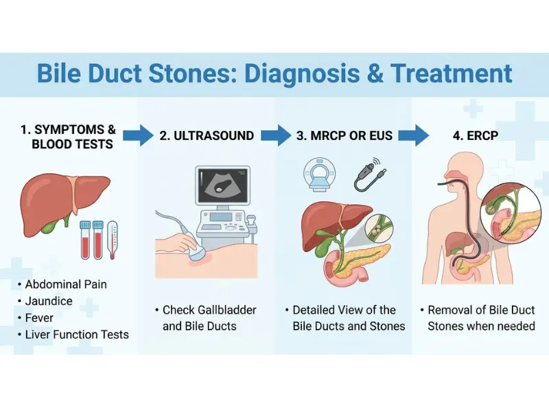 Diagnosis and treatment of bile duct stones using ultrasound MRCP EUS and ERCP